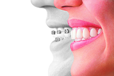 invisalign profile texas orthodontist specialists