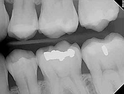 digital x-rays braces Bryan College Station